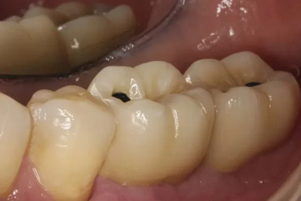 Des habitudes nefastes pour vos dents que vous devriez eviter pour une bonne hygiene bucco dentaire 2