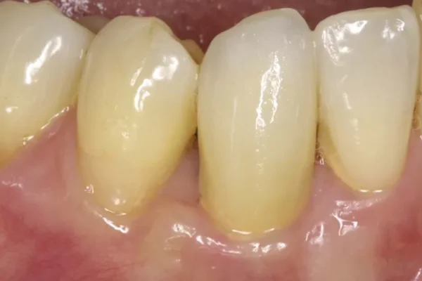 Hygiene bucco dentaire et diabete recommandations pour prendre soin de vos dents 2