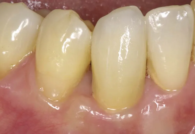 Hygiene bucco dentaire et diabete recommandations pour prendre soin de vos dents 2
