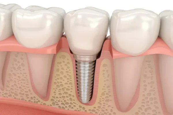 abces implant dentaire