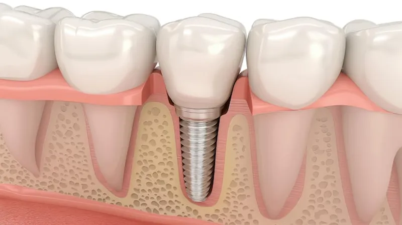abces implant dentaire