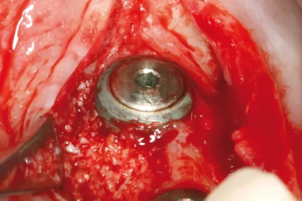 chirurgie dentaire implant