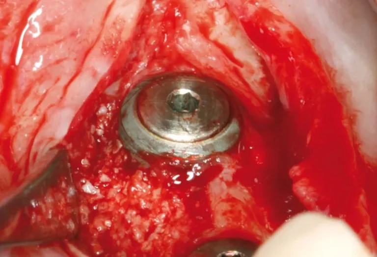 chirurgie dentaire implant