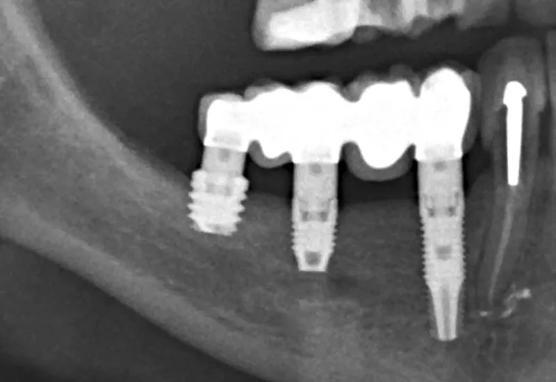 cout implants dentaires