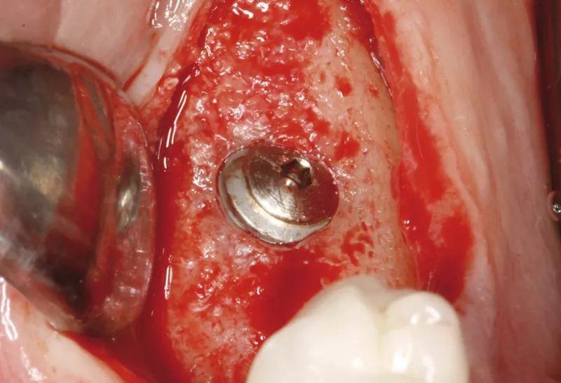 douleur implant dentaire 2 ans apres