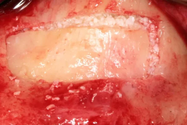 Greffe osseuse dentaire et risques d’infection: comprendre les précautions nécessaires greffe osseuse dentaire infection