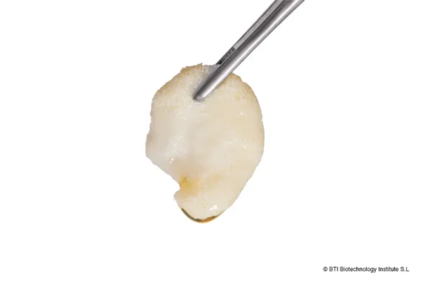 guided bone regeneration