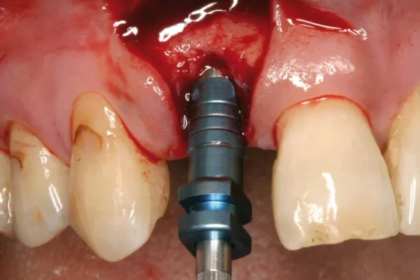 implant basal