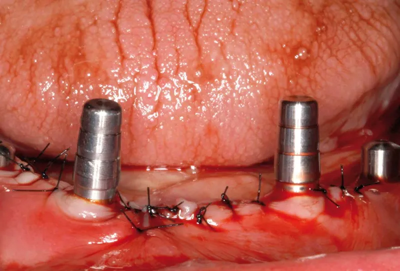 implant complications