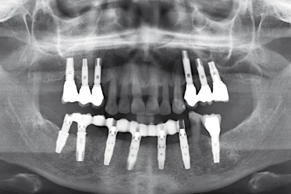 Implant dentaire bouche complète prix France – ce que vous devez savoir implant dentaire bouche complete prix france