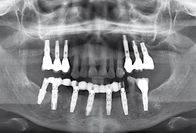 implant dentaire bouche complete prix france
