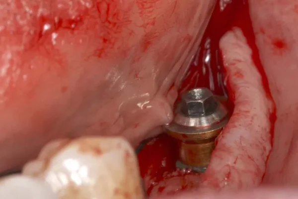 implant dentaire douleur combien de temps