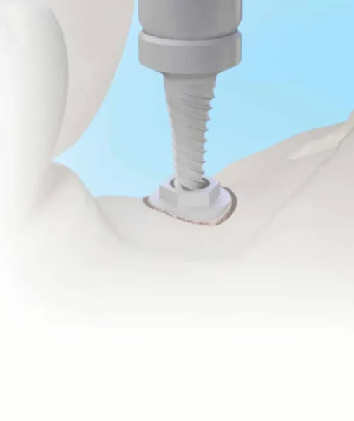 implant dentaire impossible que faire quand les options traditionnelles échouent