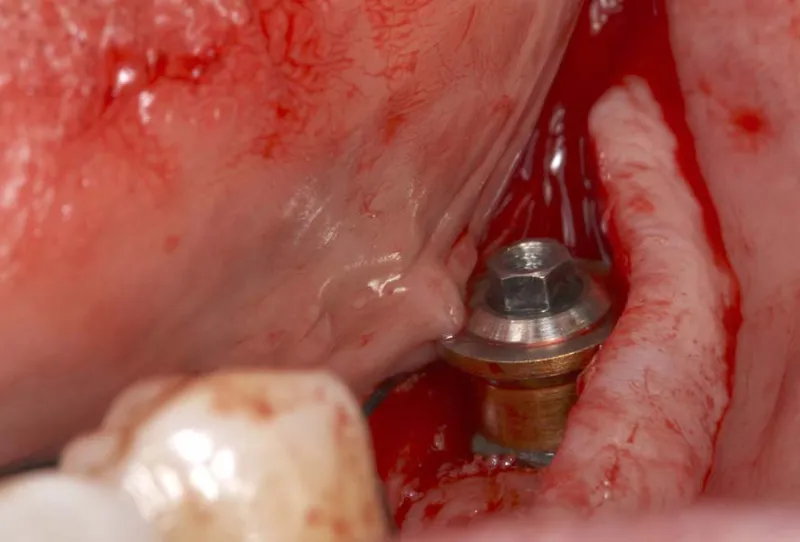 implant dentaire mal positionne