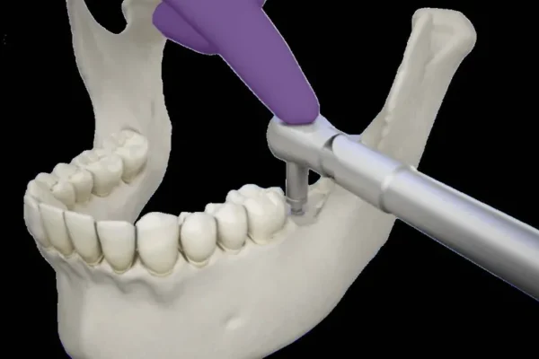 Implant zygomatique, une solution pour l’édentement sévère implant zygomatique
