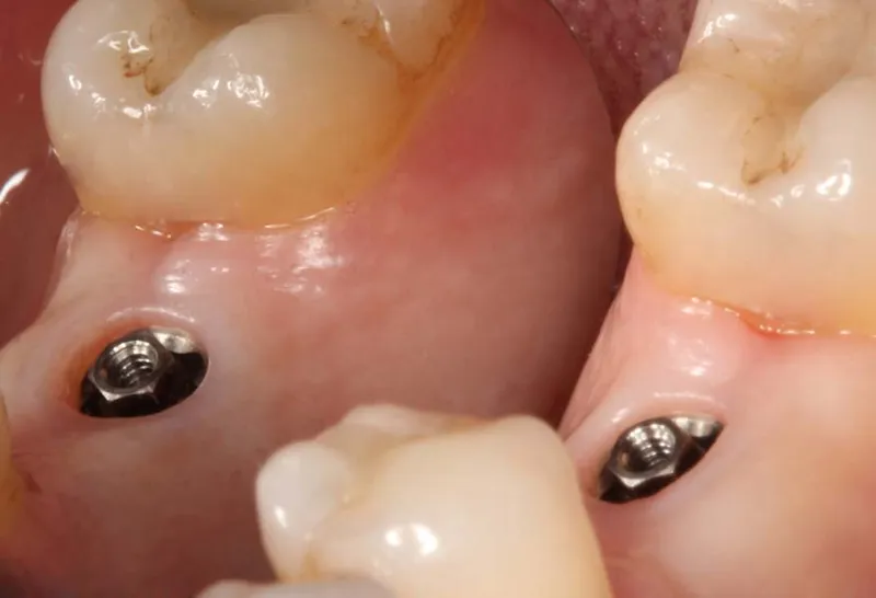 implants dentaires effets secondaires forum