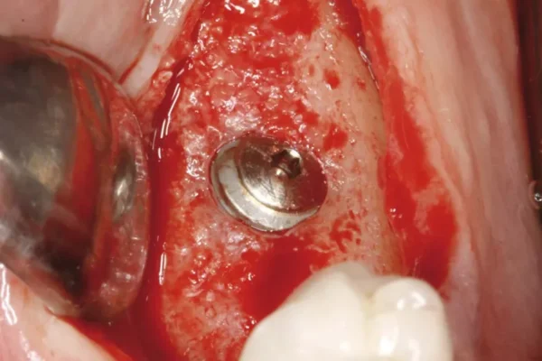 infection de limplant dentaire