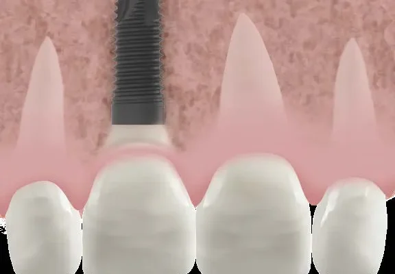 inflammation gencive suite pose couronne sur implant