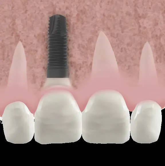 inflammation gencive suite pose couronne sur implant