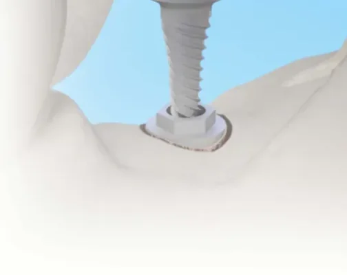 osstem implant france