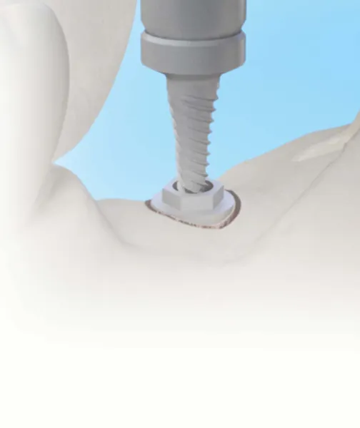 osstem implant france