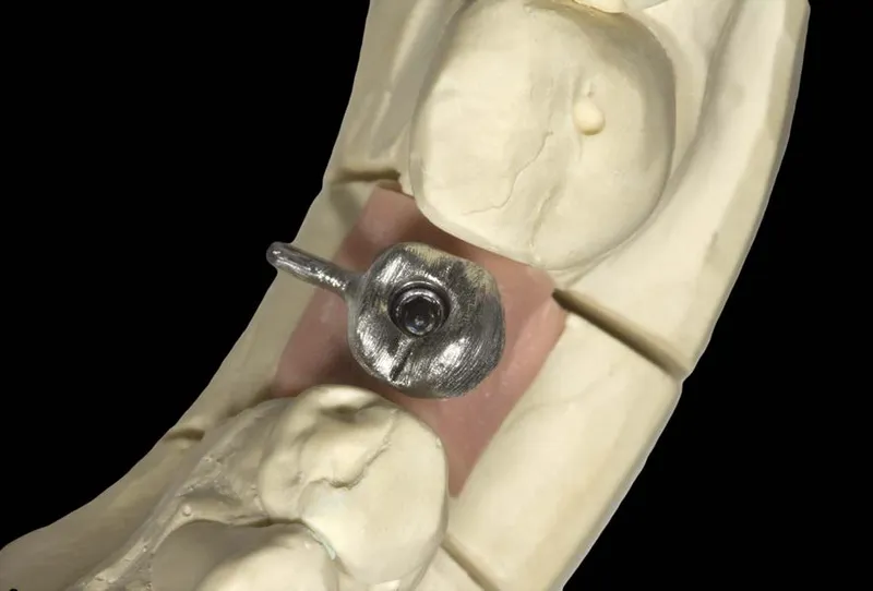 pose couronne sur implant et douleur : comprendre les sensations post-opératoires