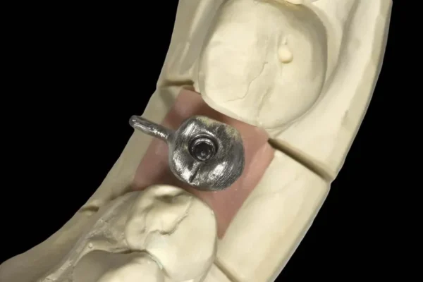 prix couronne sur implant