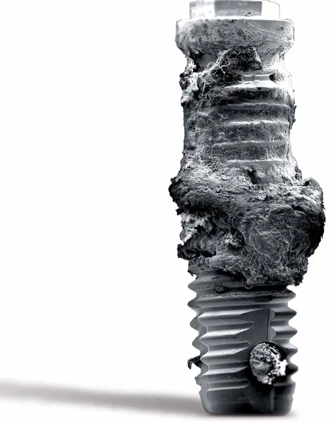 problèmes d'implant dentaire et solutions efficaces