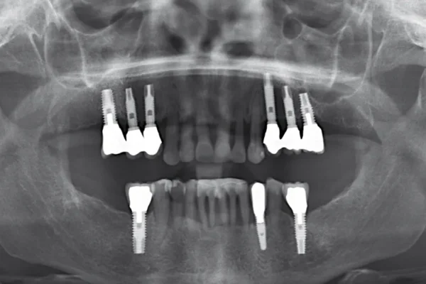 prothese fixe sur 4 implants prix en france