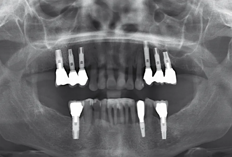 prothese fixe sur 4 implants prix en france