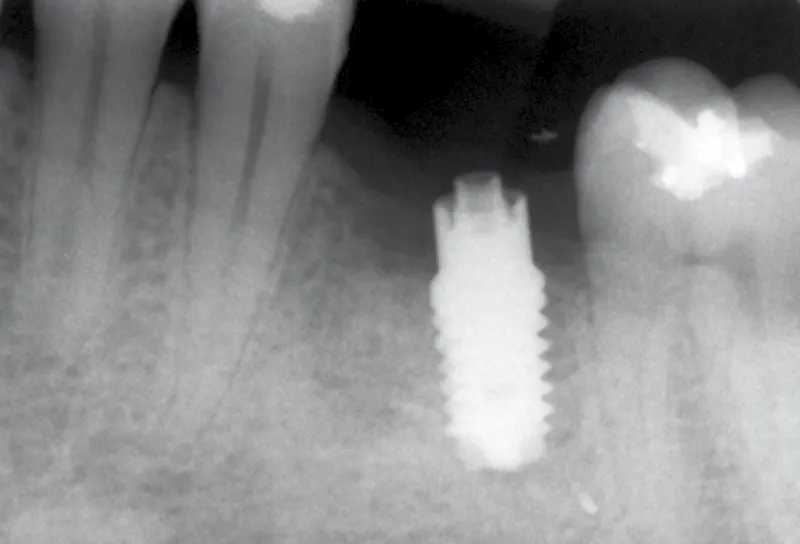 qu’est-ce qu’un implant dentaire? comprendre les bases de la dentisterie moderne