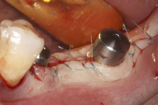 vis cicatrisation implant