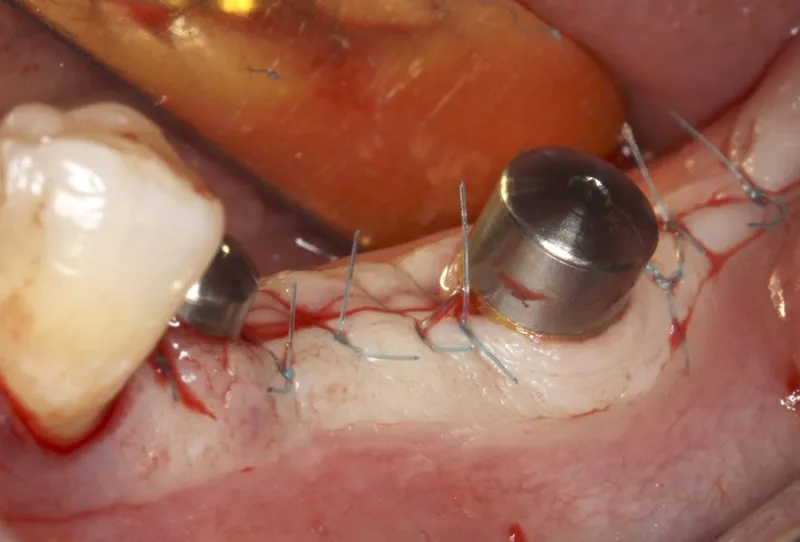 vis cicatrisation implant