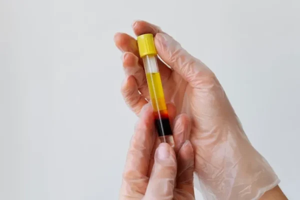 Differences entre PRGF et PRP Platelet Rich Plasma