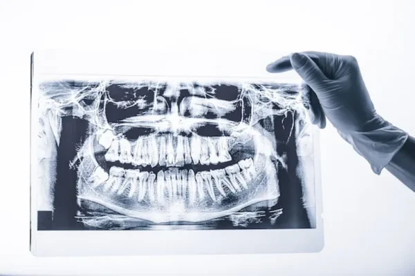 Est il necessaire de faire des radiographies pour un implant dentaire