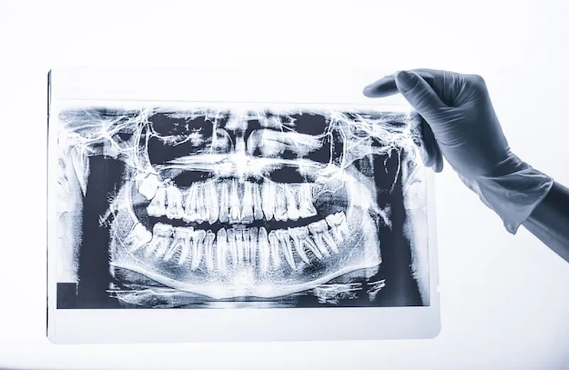 Est il necessaire de faire des radiographies pour un implant dentaire