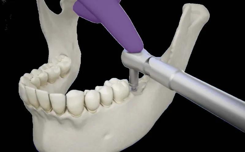 ostéointégration des implants dentaires, processus et importance pour le succès
